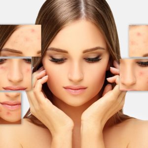 jak pozbyć się blizn po trądziku